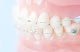インビザライン難症例には抜歯やワイヤーを併用